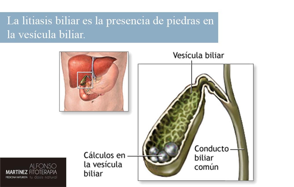 Litiasis biliar, una forma natural de tratarlas