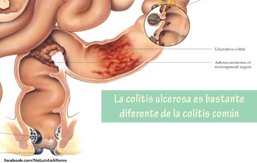 La colitis ulcerosa y su tratamiento natural.