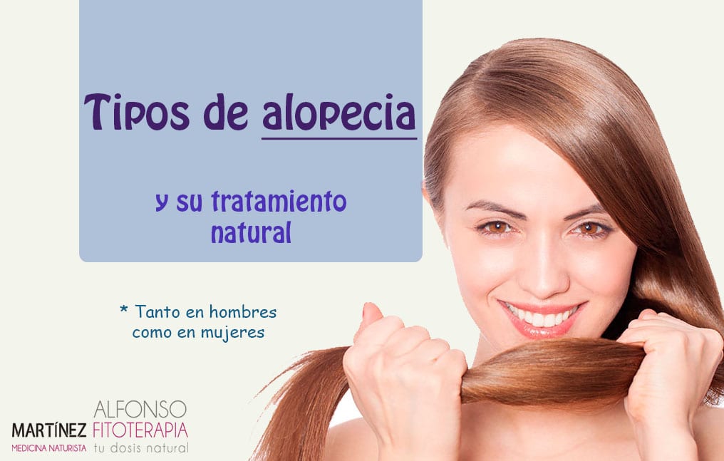 Tipos de alopecia y su tratamiento natural