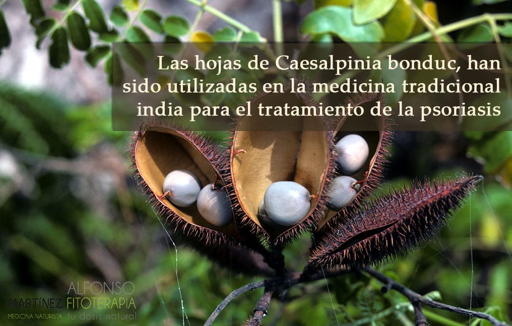 Actividad antipsoriásica de las hojas de Caesalpinia bonduc