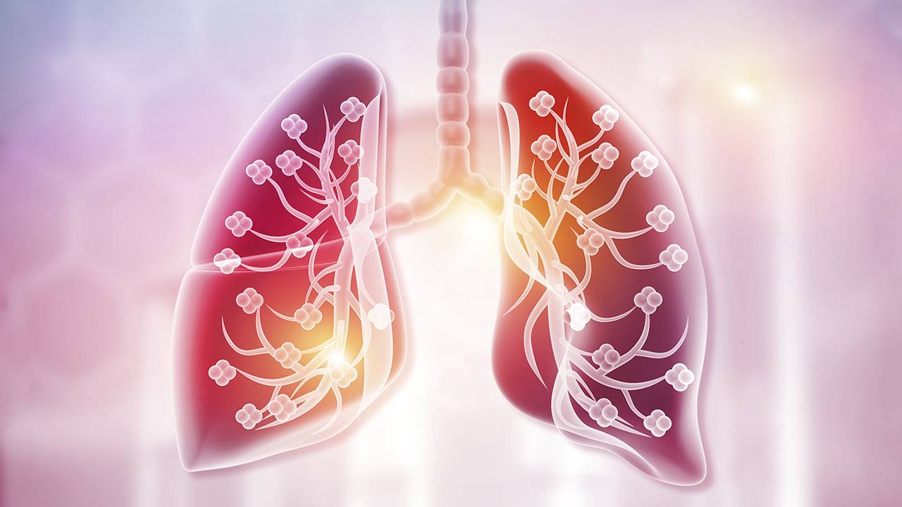 5 Remedios para los síntomas de la bronquitis