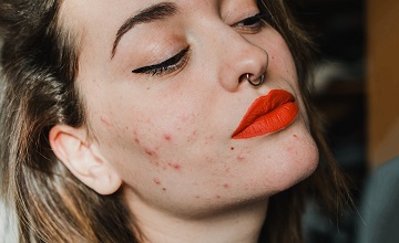 Lo que necesitas saber sobre el acné hormonal