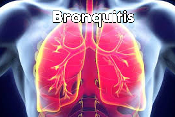 Bronquitis